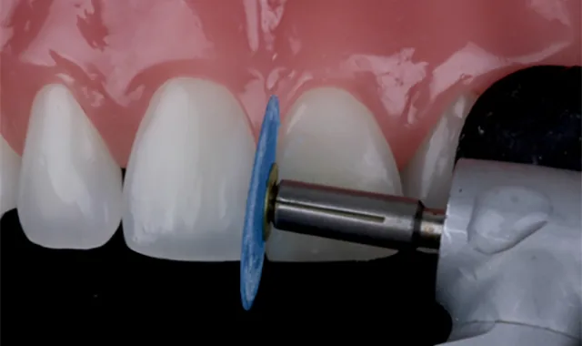 Close-up of a tooth being shaped with a polishing disc on a dental handpiece