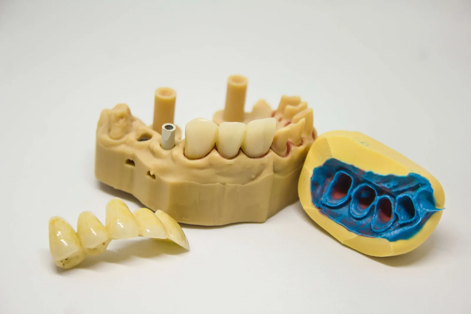 Dental Crowns